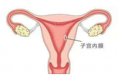 子宮內(nèi)膜異位危害大，要了解費(fèi)用早治療